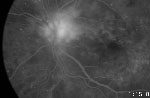 Retinopatie Diabetica Neproliferativa Medoptica